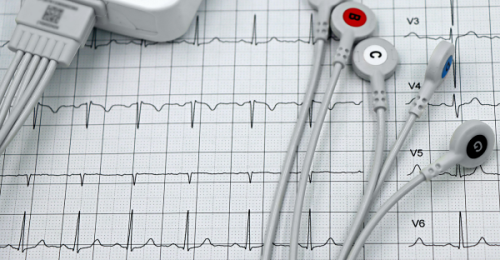 Jak interpretować wyniki badania EKG - co oznaczają najczęstsze odchylenia?
