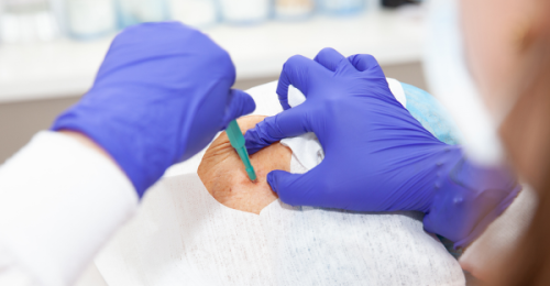 Jak wygląda przebieg badania biopsji węzłów chłonnych?